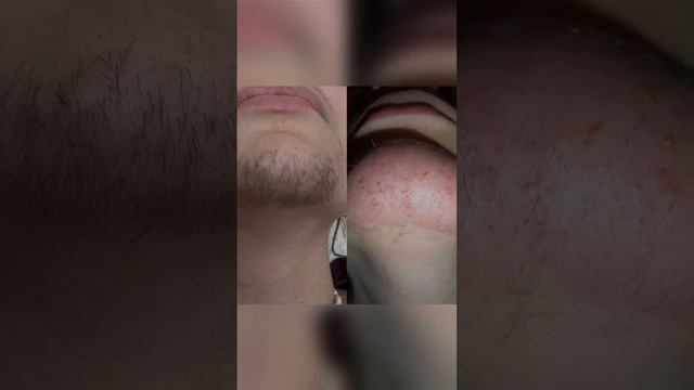 Электроэпиляция - результат одного сеанса