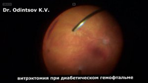 Кровоизлияние в стекловидное тело