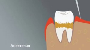 Закрытый кюретаж