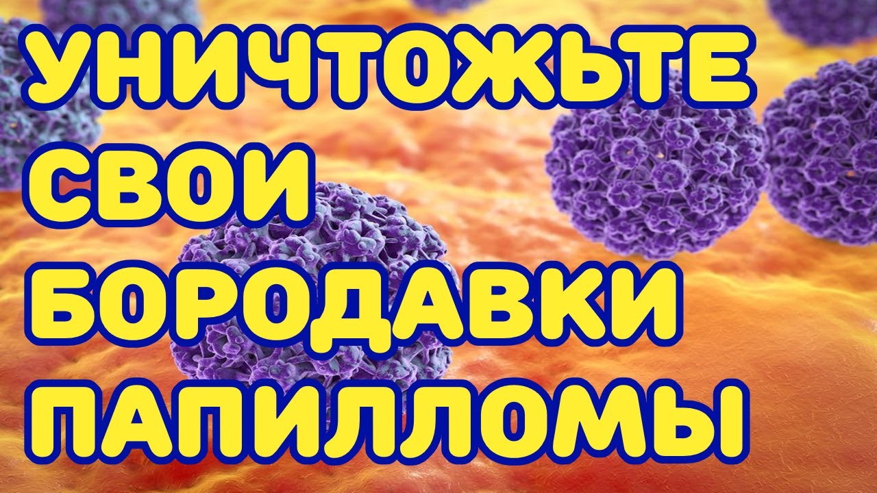 Уничтожьте свои бородавки, папилломы  Лучшие проверенные способы!.mp4 смотреть онлайн