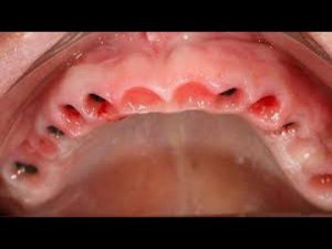 ОСТАЛСЯ БЕЗ ЗУБОВ В 20 ЛЕТ. КАКОВО ЖИТЬ БЕЗ ЗУБОВ? ПОЧЕМУ ИМПЛАНТЫ СТОЯТ ТАК ДОРОГО?