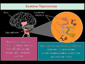 LR - тремор, болезнь Паркинсона, депрессия
