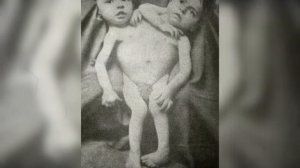5 НЕВЕРОЯТНЫХ СИАМСКИХ БЛИЗНЕЦОВ