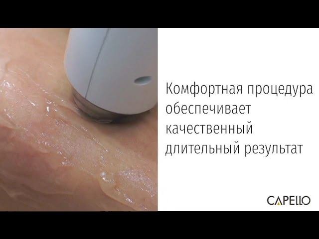 Лазерная эпиляция