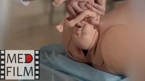 Роды при ножном предлежании плода © fetus according