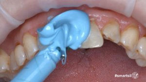 Слепок Smart Sil с имплантата открытой ложкой 11 Open Tray 4K