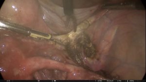 Лапароскопическая тотальная гистерэктомия с правыми придатками и левой маточной трубой.