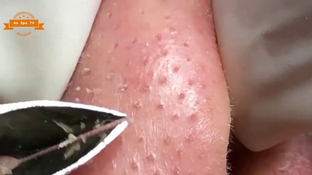 Удаление прыщей с носа и щек Spa G #089