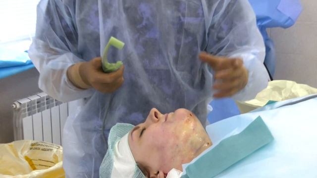 FaceTite - радиочастотный лифтинг/ убрать второй подбородок смотреть онлайн