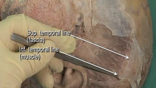 1.5 Step 3. Reflection of temporalis muscles смотреть онлайн