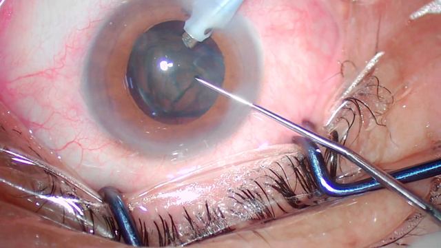 Pseudoexfoliation cataract Management Steps live commentary-Dr Kamal Kapur смотреть онлайн