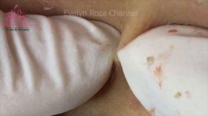 Old Blackheads Pimple Folliculitis Removal |Care Of Acne Treatment (#29)