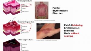 USMLE RX - 8.Анатомия - 2.Дерматология - 2.Классификация ожогов