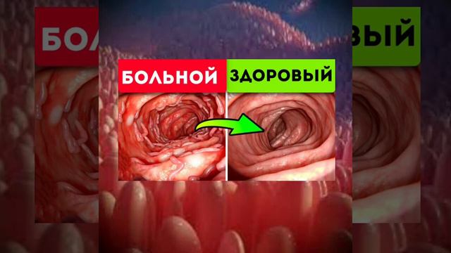 Что такое ДЫРЯВЫЙ КИШЕЧНИК ? Расскажет Ольга Алексеевна Бутакова