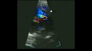 28.Аномалии конотрункуса часть2. Транспозиция магистральных и артерий и двойной выход сосудов из ПЖ