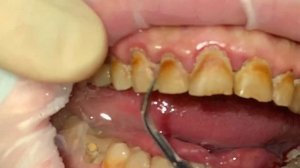 Удаление зубного камня, ультразвуковая чистка зубов / Dental plaque