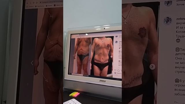 Обвисшая кожа после похудения на 100 кг. Сложный клинический случай