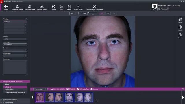 FotoFinder Adonia Deluxe - обзор системы смотреть онлайн