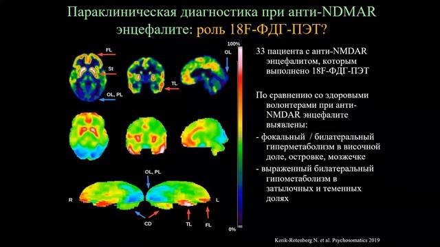 Аутоиммунный энцефалит: эпидемиология, клиника, принципы диагностики и терапии