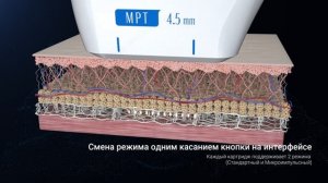 SMAS-лифтинг Ultraformer MPT | Сеть клиник косметологии GEN87