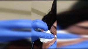 подборка вылавливания прыщей 26 II выдавливание прыщей