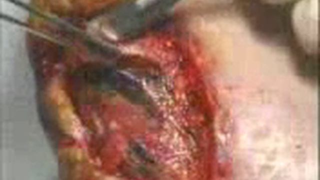 Gangrena palse stopa смотреть онлайн