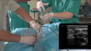 Подключичная блокада плечевого сплетения однократная