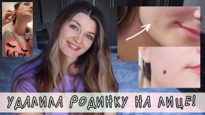 УДАЛИЛА РОДИНКУ лазером на лице - как заживает удаленная родинка, отзыв после удаления родинки