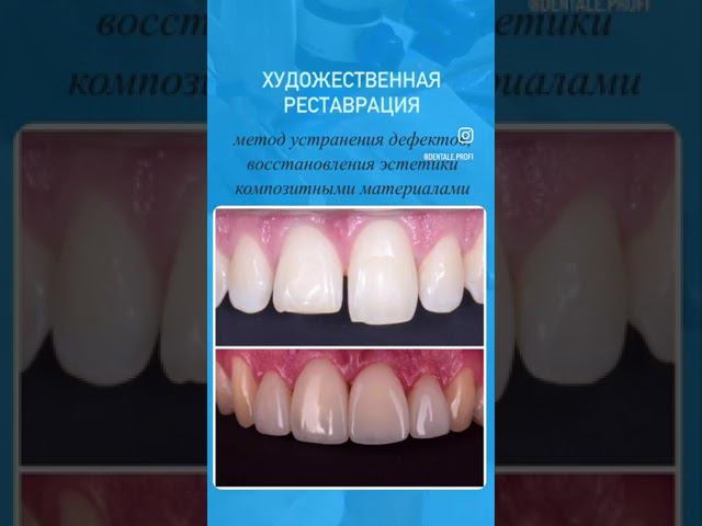Художественная реставрация улыбки в Денталь Профи #стоматология #реставрациязубов #эстетика