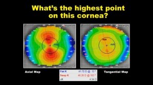 Webinar | What eye shape reveals about contact lens fit