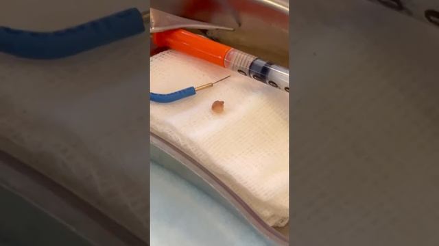 Удаление родинки в 100med смотреть онлайн