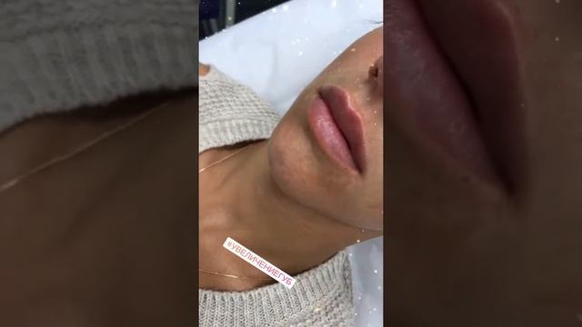 Контурная пластика губ - Косметолог Dr.Aina (Москва) смотреть онлайн