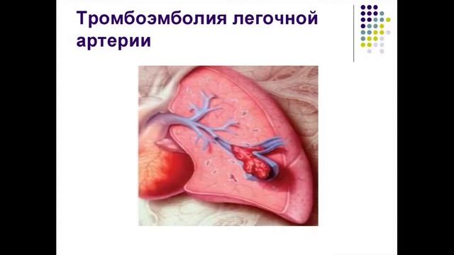 ВАРИКОЗНОЕ РАСШИРЕНИЕ ВЕН НИЖНИХ КОНЕЧНОСТЕЙ