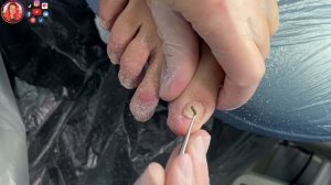 Установка титановой нити / Коррекция вросшего ногтя