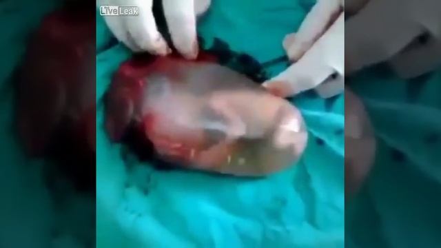 Выкидыш 16 недель. Живой, а помочь невозможно