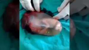 Выкидыш 16 недель. Живой, а помочь невозможно