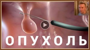 ДОБРОКАЧЕСТВЕННЫЕ ОПУХОЛИ - ПРОФИЛАКТИКА ЛЕЧЕНИЕ
