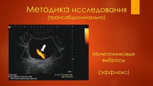 УЗИ мочевого пузыря. Станислав Феданов.