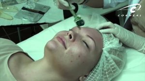 Микронидлинг идеальная процедура для тех кому за 60