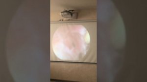 Гистероскопия - Полипэктомия