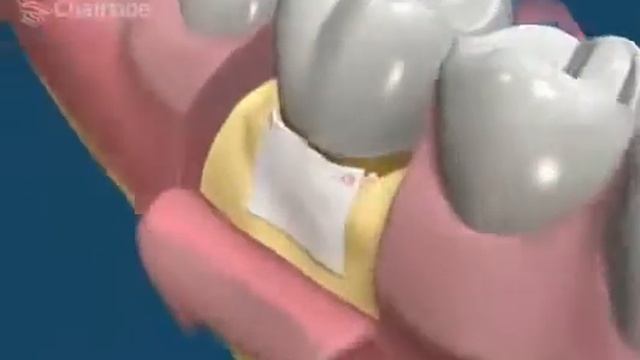 Направленная регенерация Обучающее видео для стоматологов смотреть онлайн