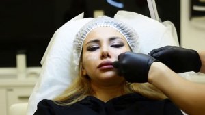 УВЕЛИЧЕНИЕ СКУЛ / Dr Sitanovich