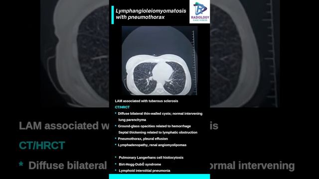 Lymphangioleiomyomatosis with pneumothorax