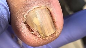 Completely broken onychomycosis, pulling out embedded nails【Doctor Liu Pedicure】