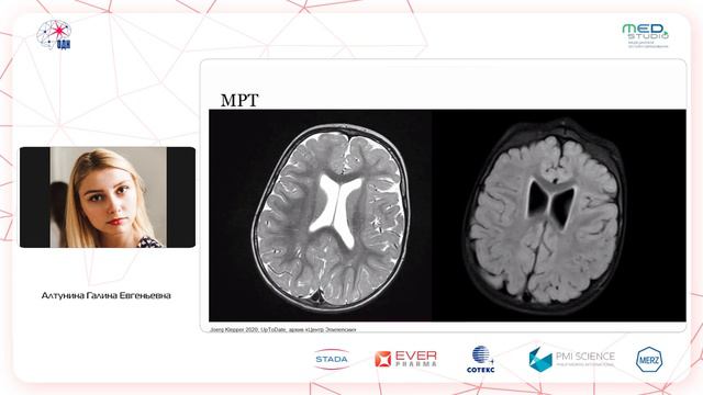 Эпилепсия при дефиците переносчика глюкозы. Болезнь де Виво. Алтунина Г.Е. смотреть онлайн