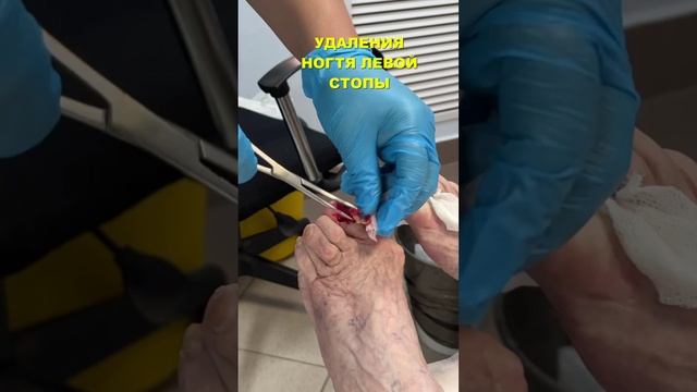 Удаление ногтевых пластинок смотреть онлайн