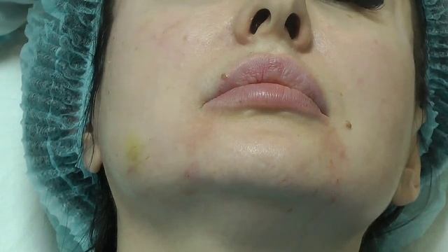 Коррекция носогубных складок и морщин марионеток филлерами на основе гиалуроновой кислоты.
