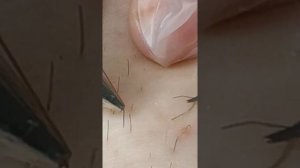 Электроэпиляция на аппарате Шмель-1000 в Москве