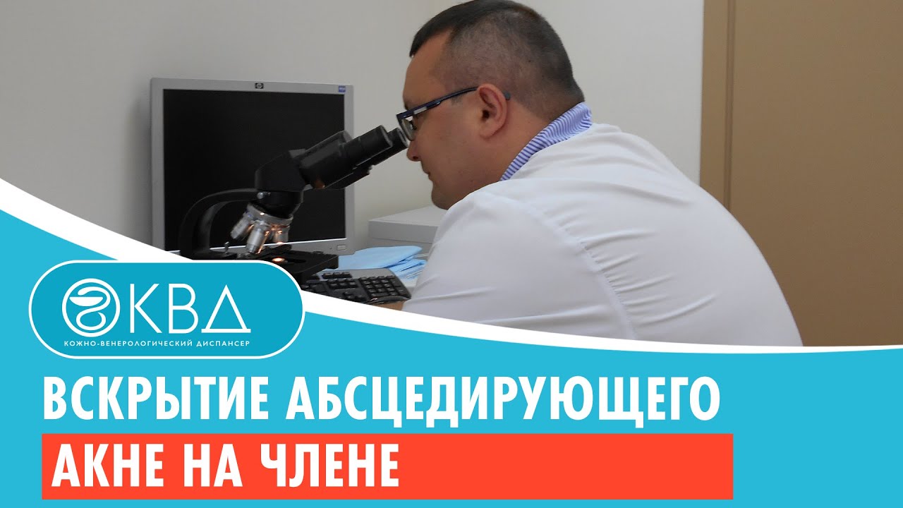 ? Вскрытие абсцедирующего акне на члене. Клинический случай №188