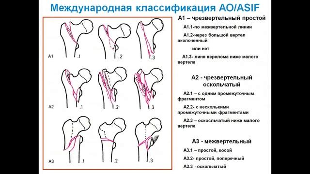 Переломы проксимального отдела бедренной кости. Лекция.